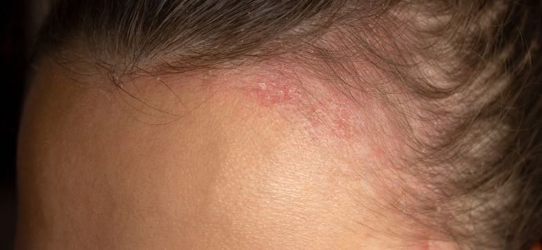 Saiba identificar e como tratar dermatite seborreica no couro cabeludo - Amanda Esperancin