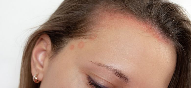 Foliculite dissecante: sinais, diagnóstico e opções de tratamento - Amanda Esperancin