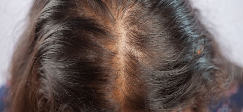 Alopecia androgenética tem cura? O que é possível tratar - Amanda Esperancin