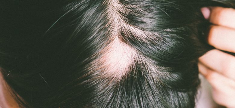 Tipos de alopecia: como saber qual você tem - Amanda Esperancin