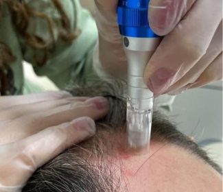 Microagulhamento Capilar