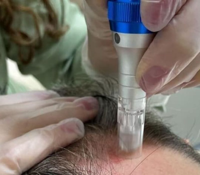 microagulhamento capilar - amanda esperancin