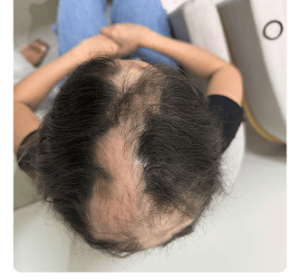 Caso de Alopecia areata 3