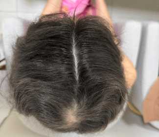 Caso de Alopecia areata 4