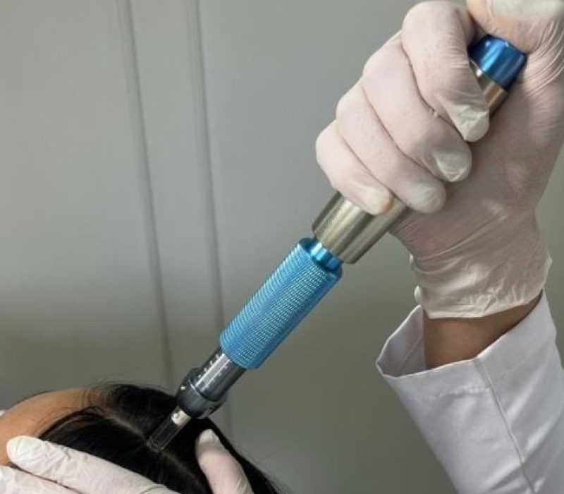 Intradermoterapia Pressurizada Capilar