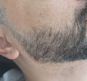 Crescimento de Barba - Antes