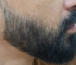 Crescimento de Barba - Depois
