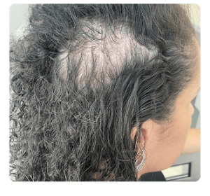 caso de Alopecia Androgenética e Eflúvio Telógeno 1