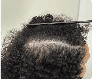 caso de Alopecia Androgenética e Eflúvio Telógeno 2