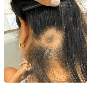 caso de Alopecia Areata Localizada​ 1