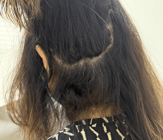 caso de Alopecia Areata Localizada​ 2