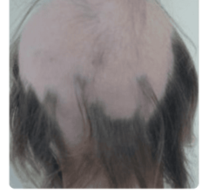 caso de Alopecia Areata Ofiásica 1