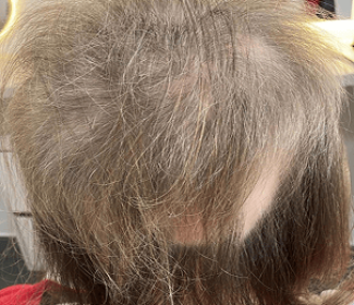 caso de Alopecia Areata Ofiásica 2