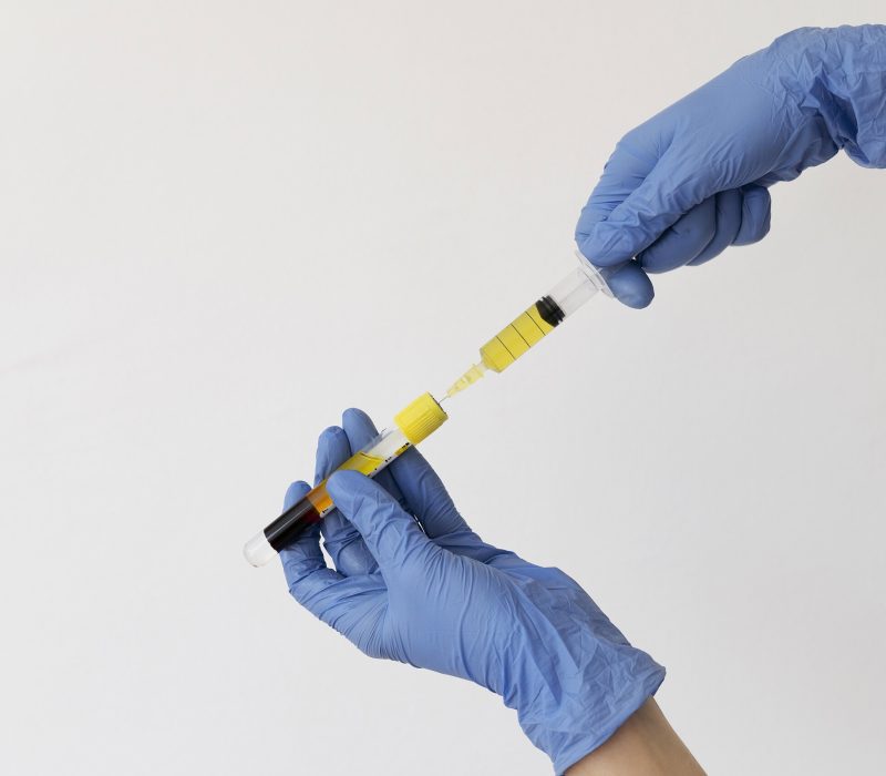 PRP Capilar (Plasma Rico em Plaquetas)
